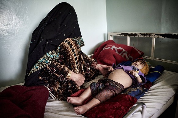 An Afghan mother at the side of her child suffering from severe malnutrition, at Kandahar Mirwais Hospital. PUBLICATIONxNOTxINxFRAxRUS AntoninxBuratx/xLexPictorium LePictorium_0271018