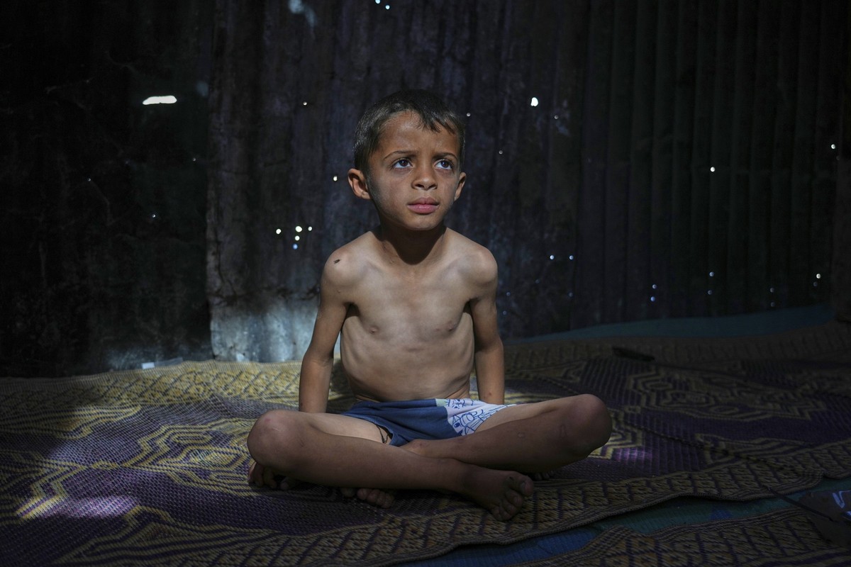 Ahmed El-Sheikh Eid, 7, who shows signs of malnutrition, poses for a photo at his family tent at a camp for displaced Palestinians in Mawasi Khan Younis, Gaza Strip, Friday, May 2, 2025. (AP Photo/Abd ...