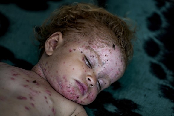 Displaced child Sham al-Hessi, who suffers from skin disease, sleeps at a makeshift tent camp in Deir al-Balah, central Gaza Strip, Monday, July 29, 2024. Skin diseases are running rampant in Gaza, he ...